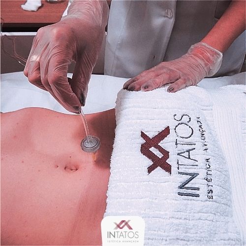 CARBOXITERAPIA